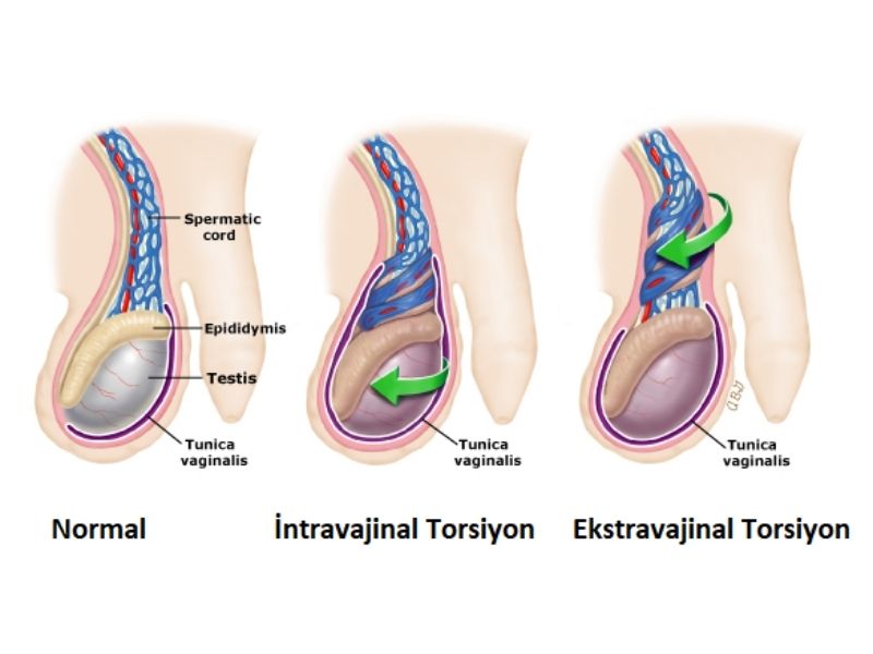 testis-torsiyonu-nedir