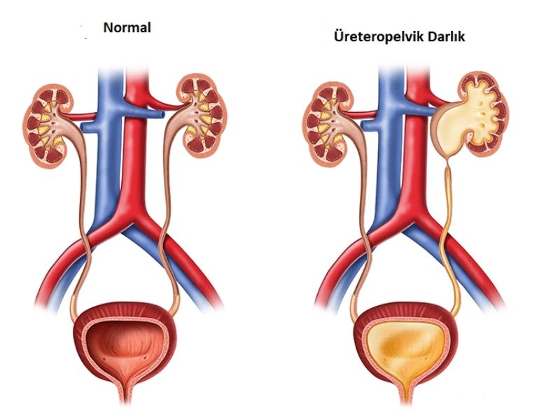 ureteropelvik-darlik-nedir
