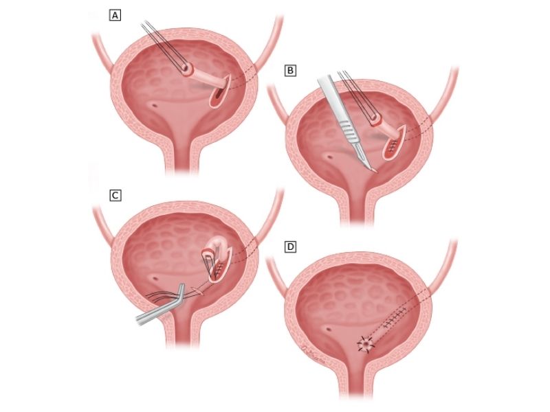 vezikoureteral-reflu-tedavisi-nedir